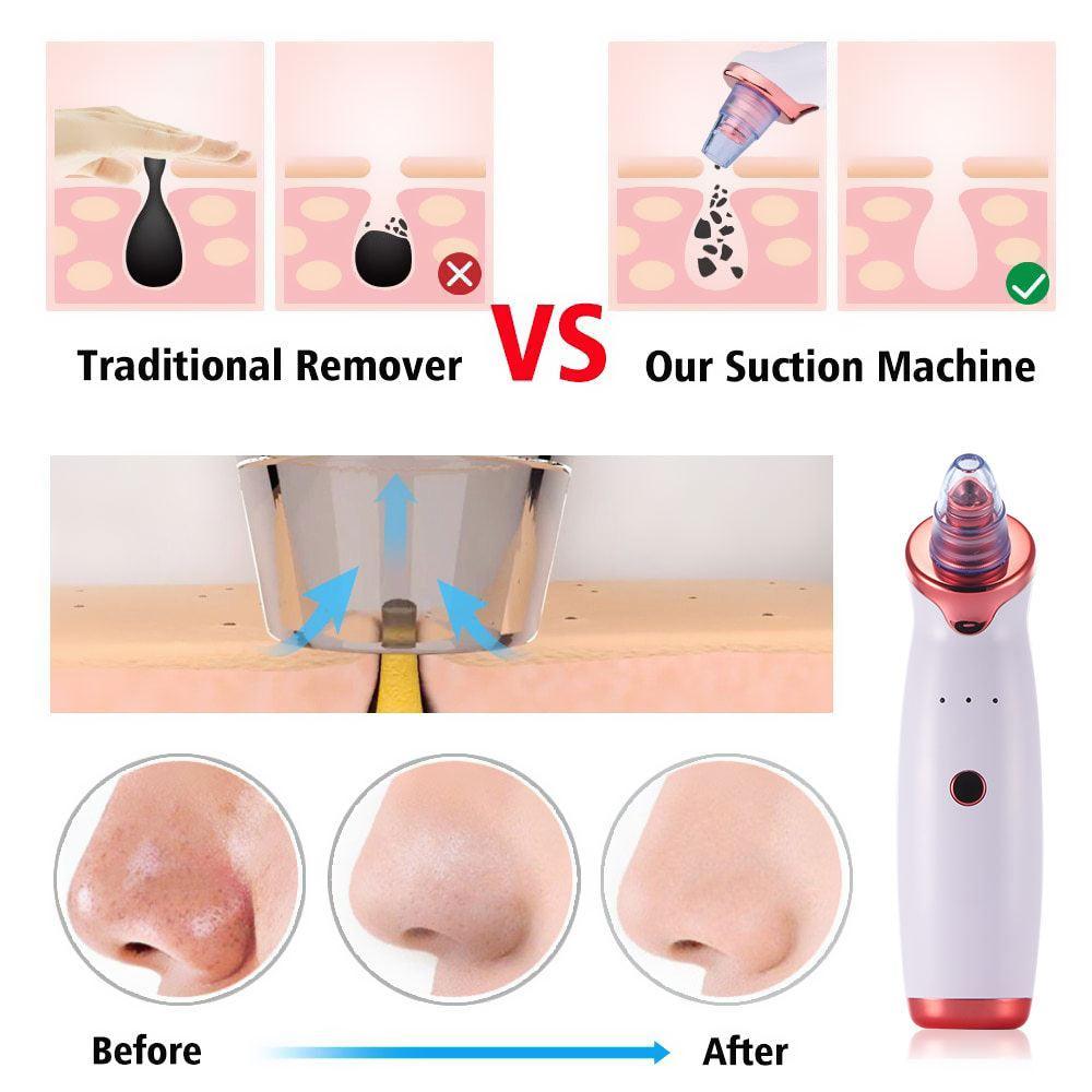 Electric Acne Remover Blackhead Remover Apparatus - VirtuousWares:Global