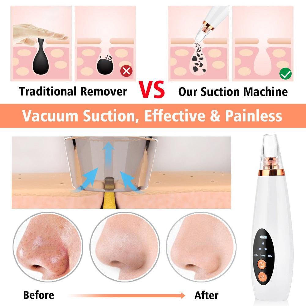 Facial Pore Cleaner Blackhead Remover Vacuum Suction Cleaner Pore Acne - VirtuousWares:Global