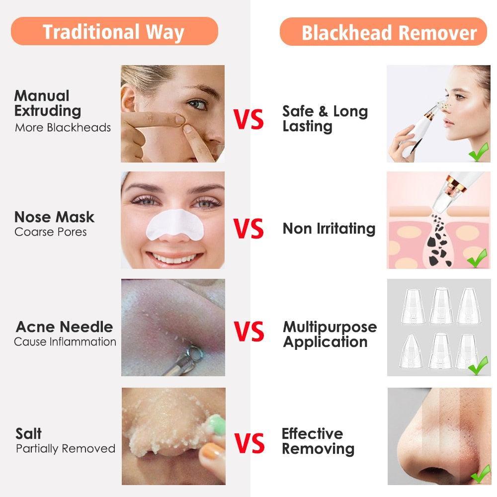 Facial Pore Cleaner Blackhead Remover Vacuum Suction Cleaner Pore Acne - VirtuousWares:Global