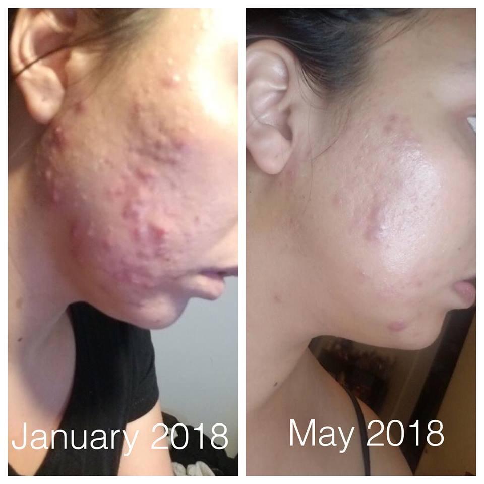 Super Acne Fighter / Organic Acne Treatment / Acne / Essential Oils / - VirtuousWares:Global