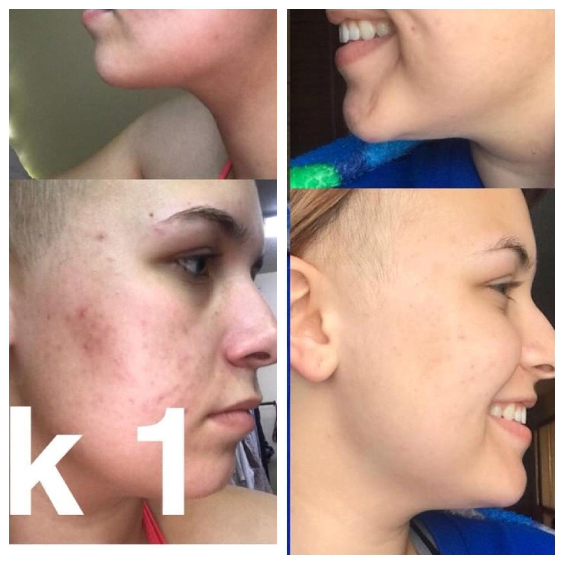 Super Acne Fighter / Organic Acne Treatment / Acne / Essential Oils / - VirtuousWares:Global