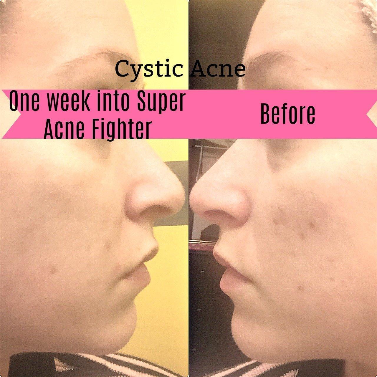 Super Acne Fighter / Organic Acne Treatment / Acne / Essential Oils / - VirtuousWares:Global