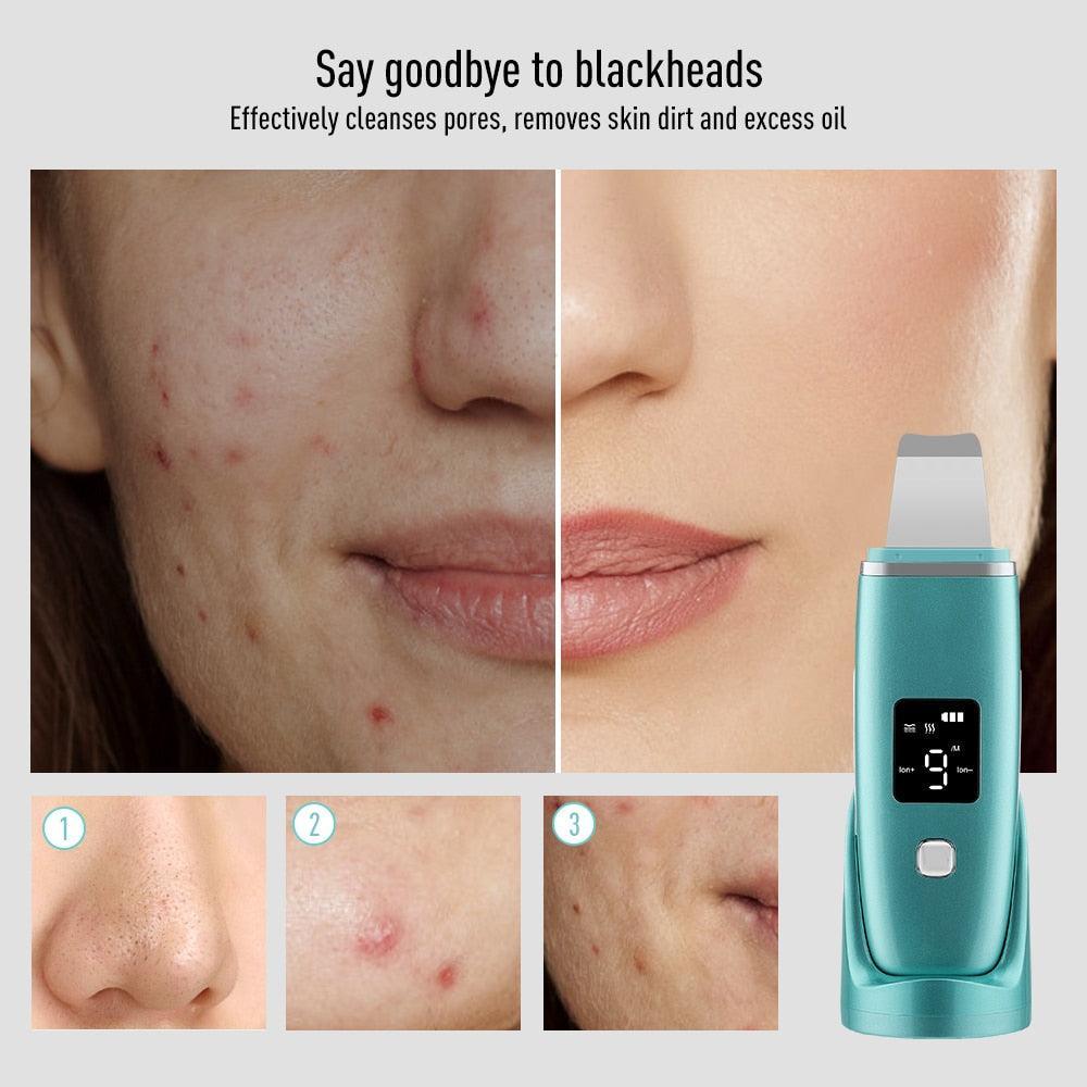 Ultrasonic Skin Scrubber EMS Facial Pore Deep Cleansing Spatula - VirtuousWares:Global