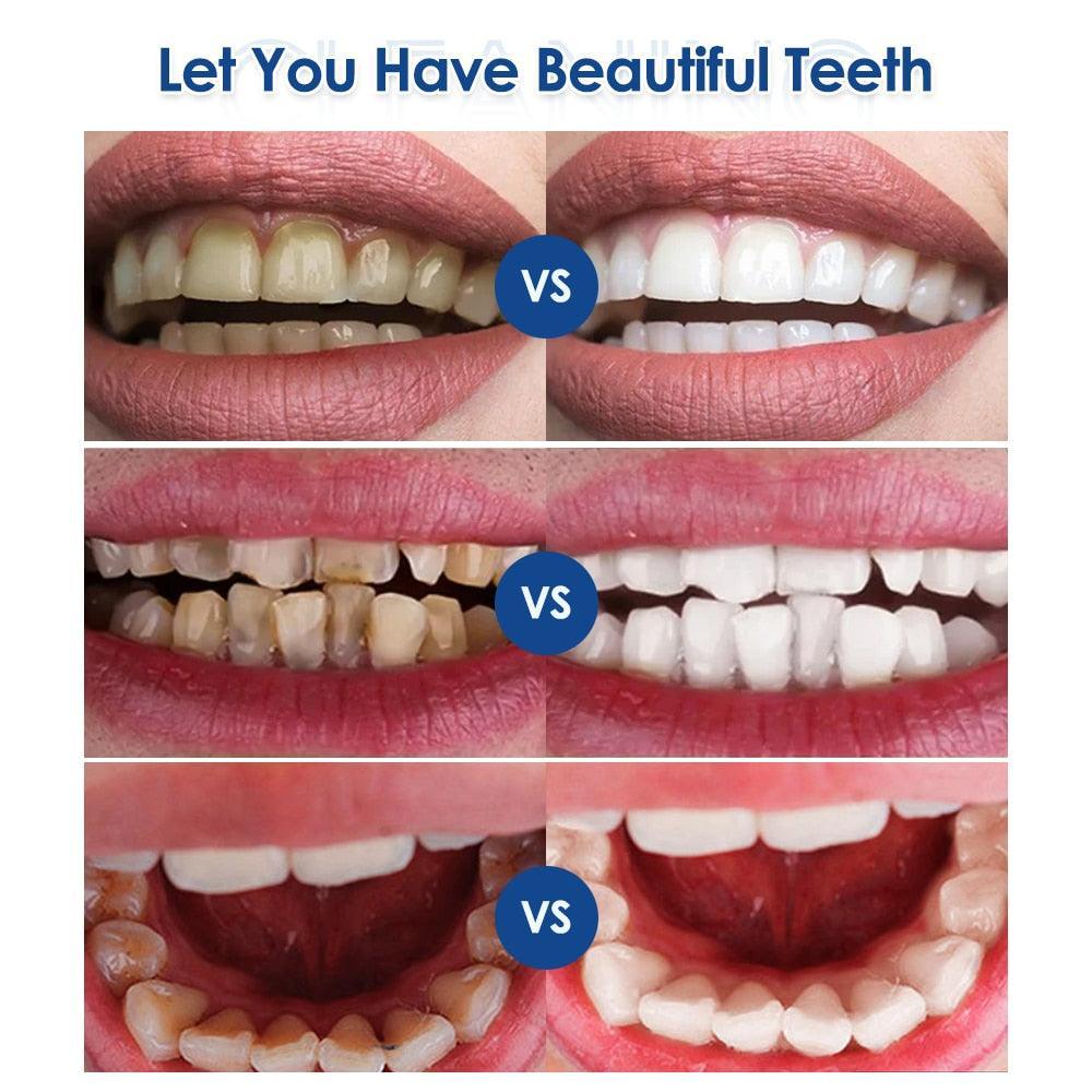 Ultrasonic Visual Dental Cleaning Teeth Whitening Kit Tartar - VirtuousWares:Global